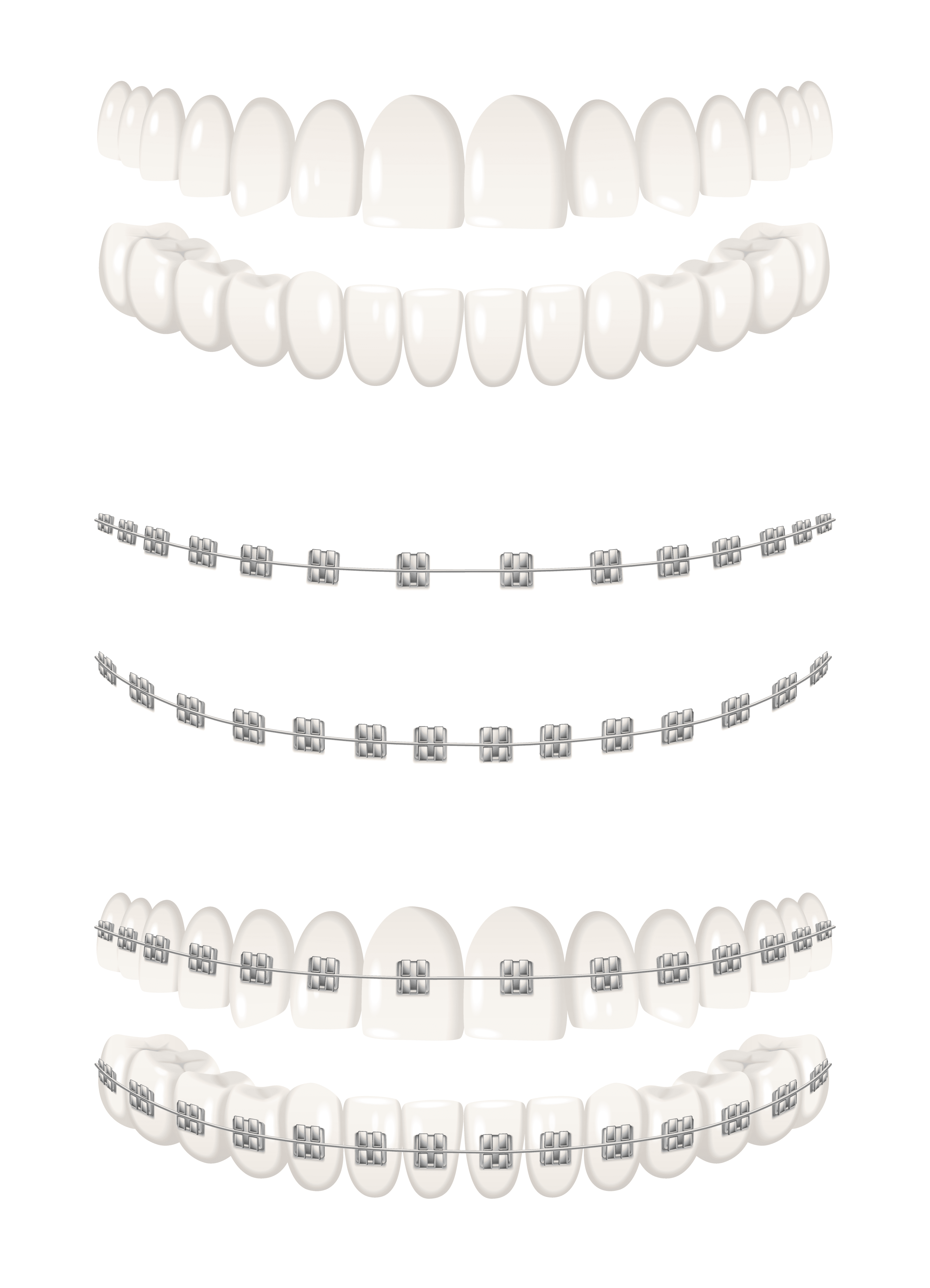 Best dental Brace Treatment in Nizampet