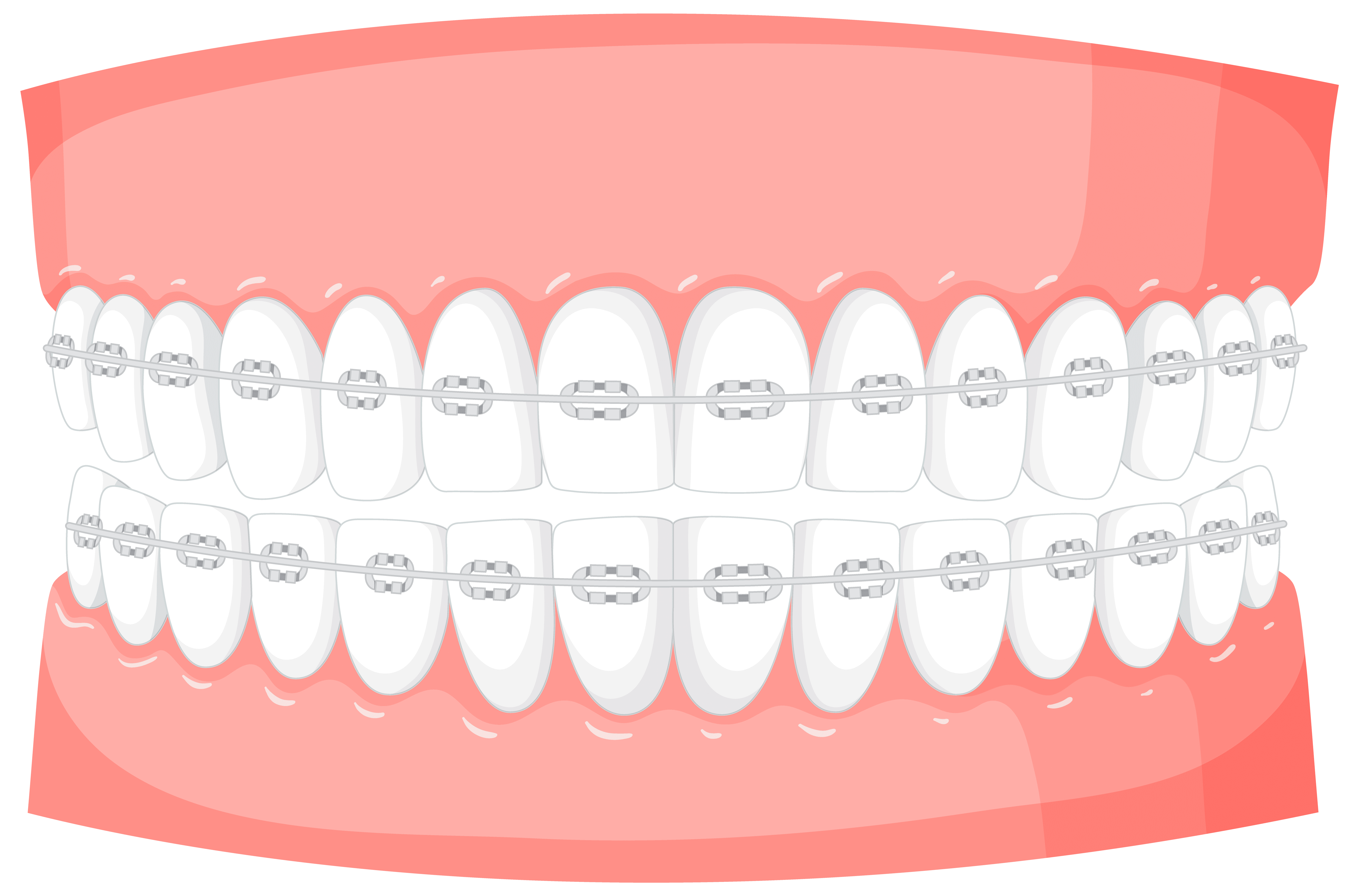 Best Dental Brace treatment in Nizampet