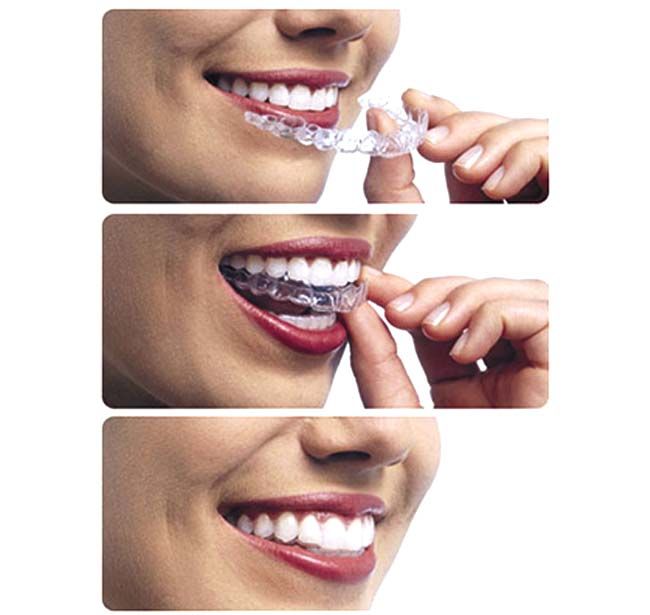 Invisible Aligner Treatment Work at Nizampet Dentist