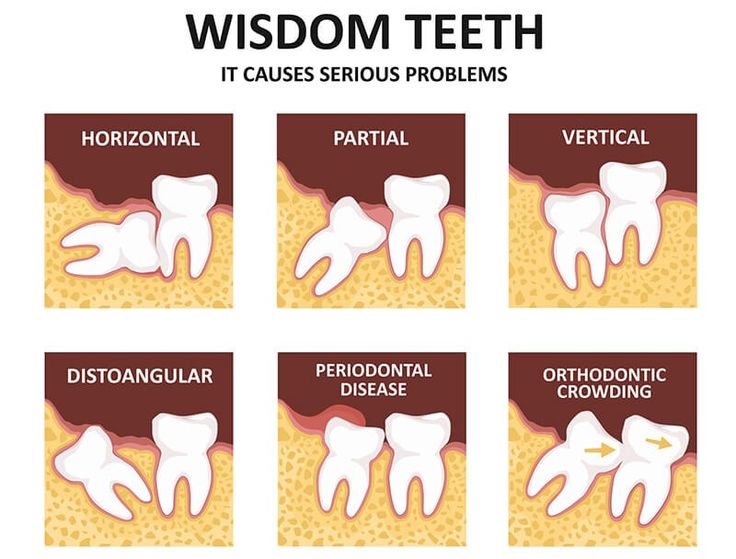 Best Wisdom Teeth Treatment in Nizampet