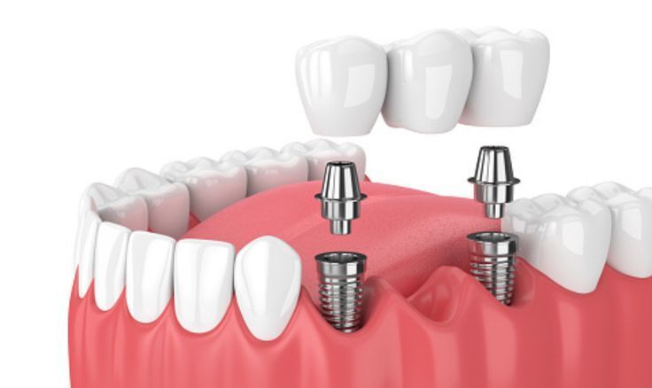 Best Dentures Treatment in Nizampet