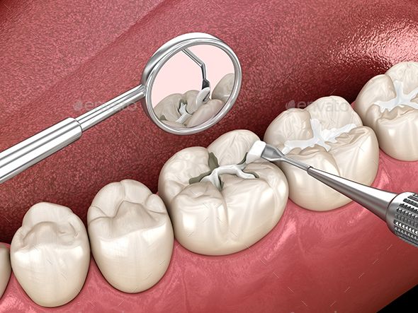 What are Dental Filling
