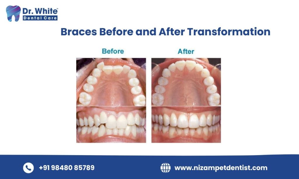 Braces Before and After Transformation