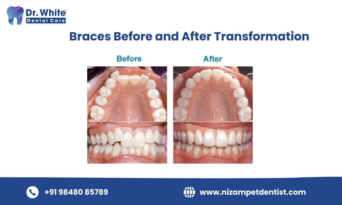 Braces Before and After Transformation