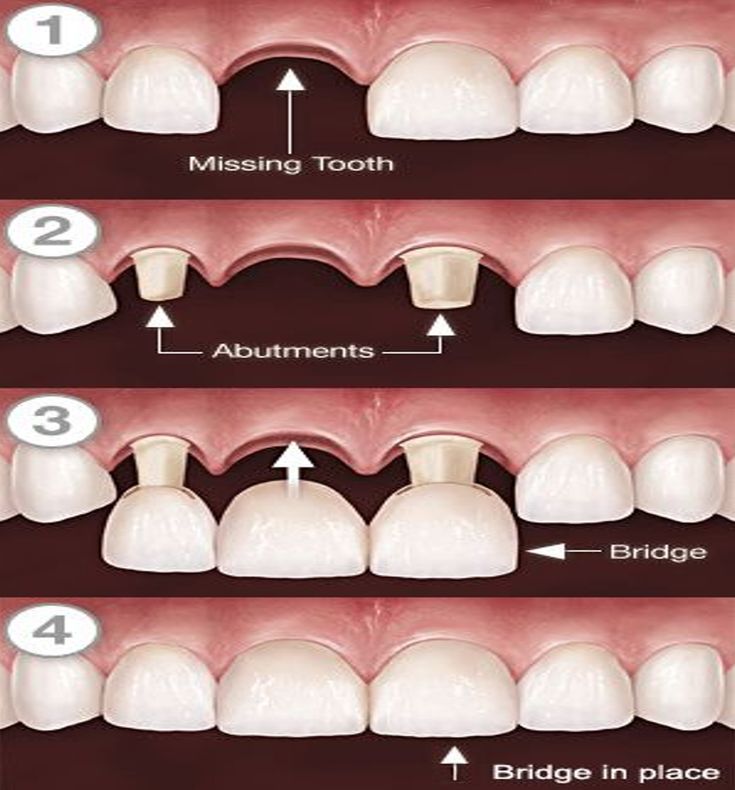Treatable Cases with Crowns and Bridges