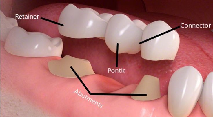 Types of Crown and bridges