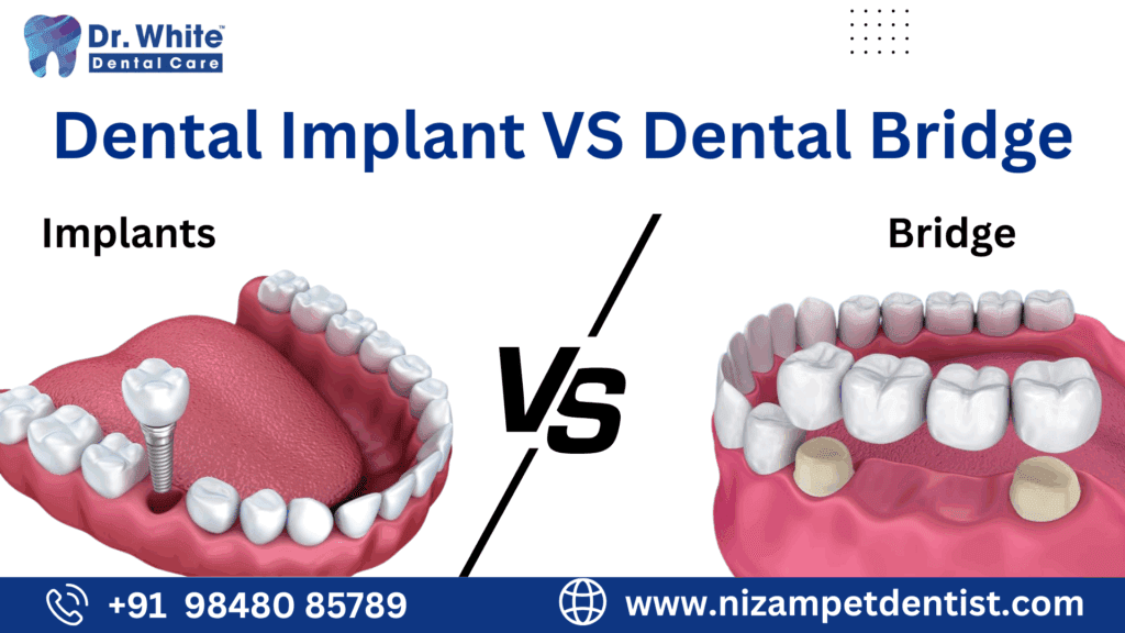 Dental Implant VS Dental Bridge