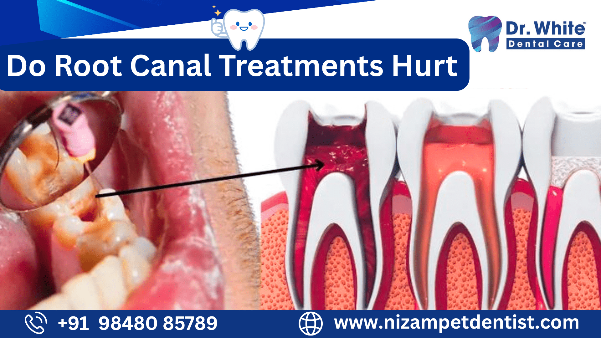 Do Root Canal Treatments Hurt