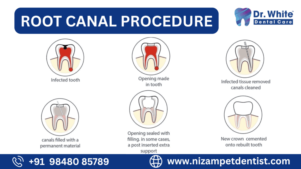 Do Root Canal Treatments Hurt