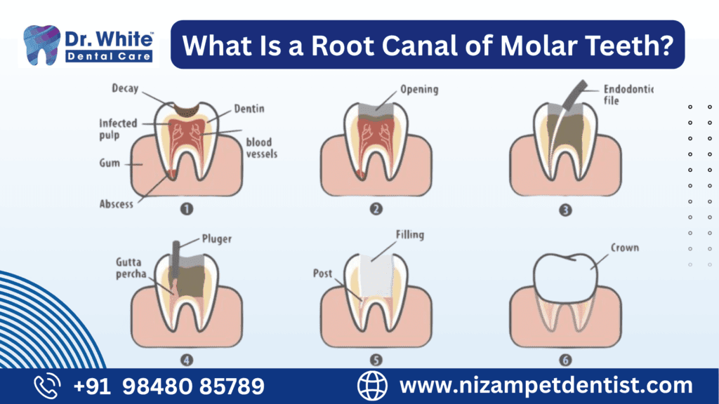 Root Canal of Molar Teeth