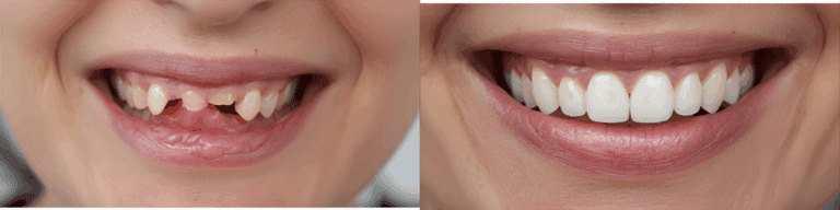 Dental full implant before and after 1