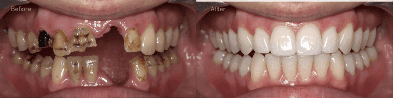 Dental full implant before and after 2