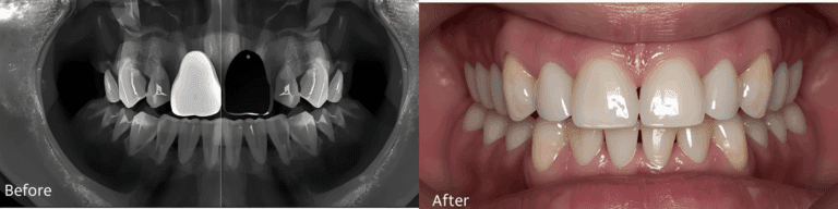 Dental full implant before and after 3
