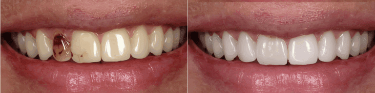 Dental full implant before and after 4