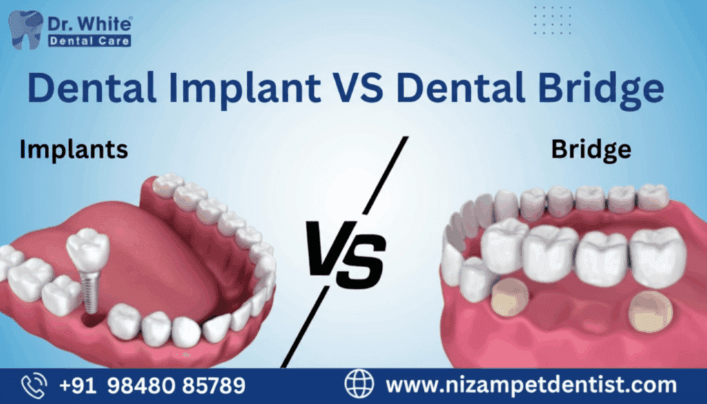 Dental Implant vs Dental bridge
