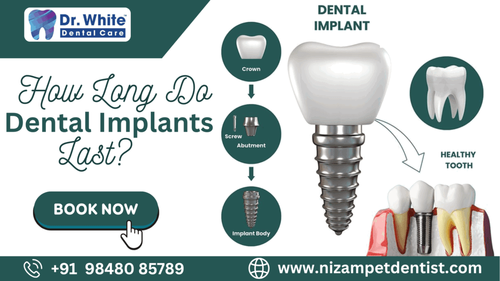 How Long Do Dental Implants Last?