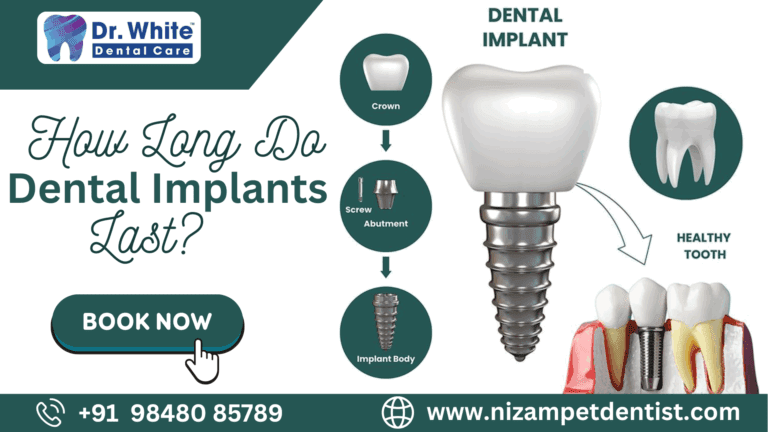 How Long Do Dental Implants Last?