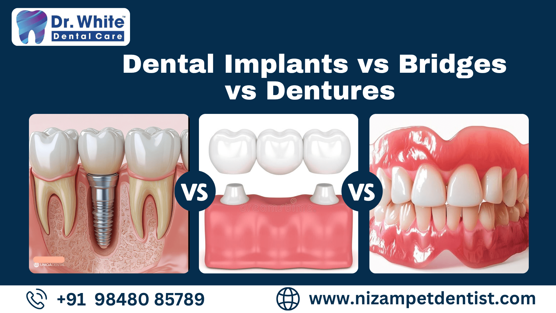 Dental Implants vs Bridges vs Dentures