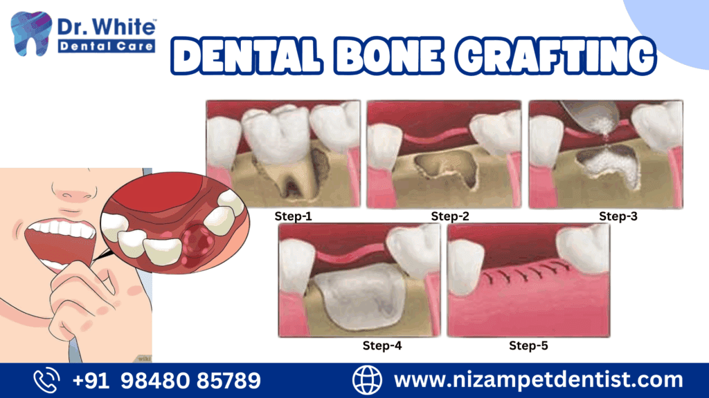 What is a Dental Bone Graft