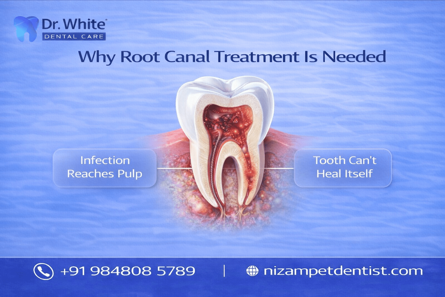 Why root canal treatment is needed