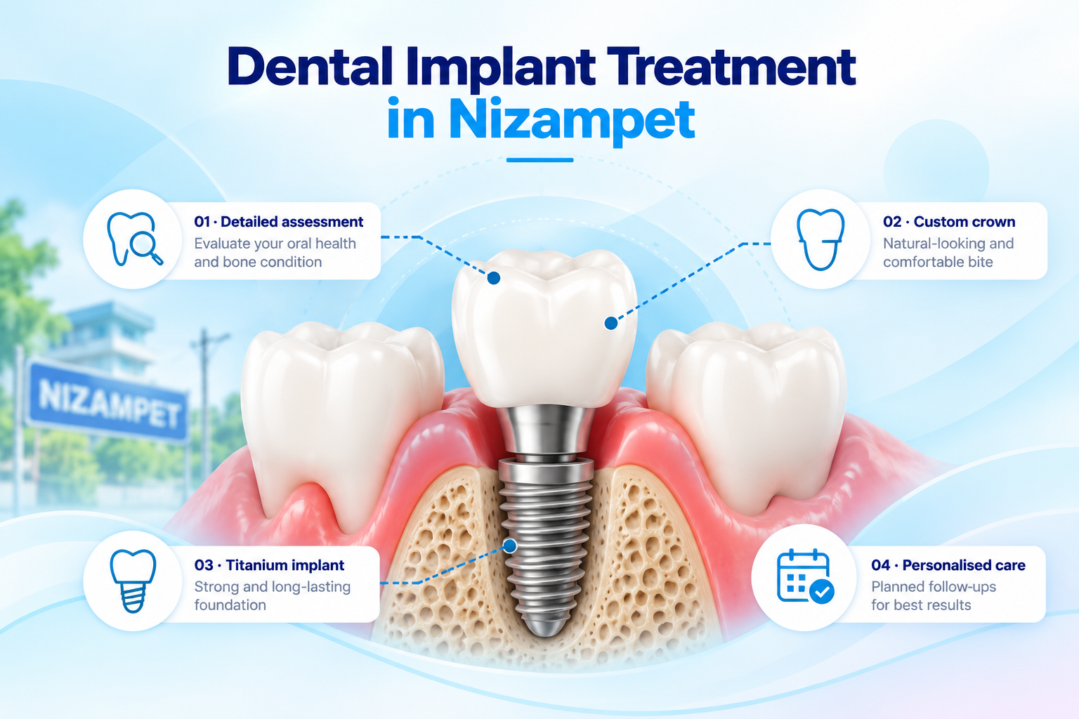 Dental implant treatment in Nizampet illustration showing a titanium implant, abutment and dental crown replacing a missing tooth