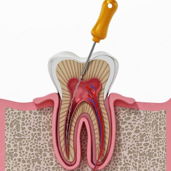 Best Root Canal Treatment in Nizampet