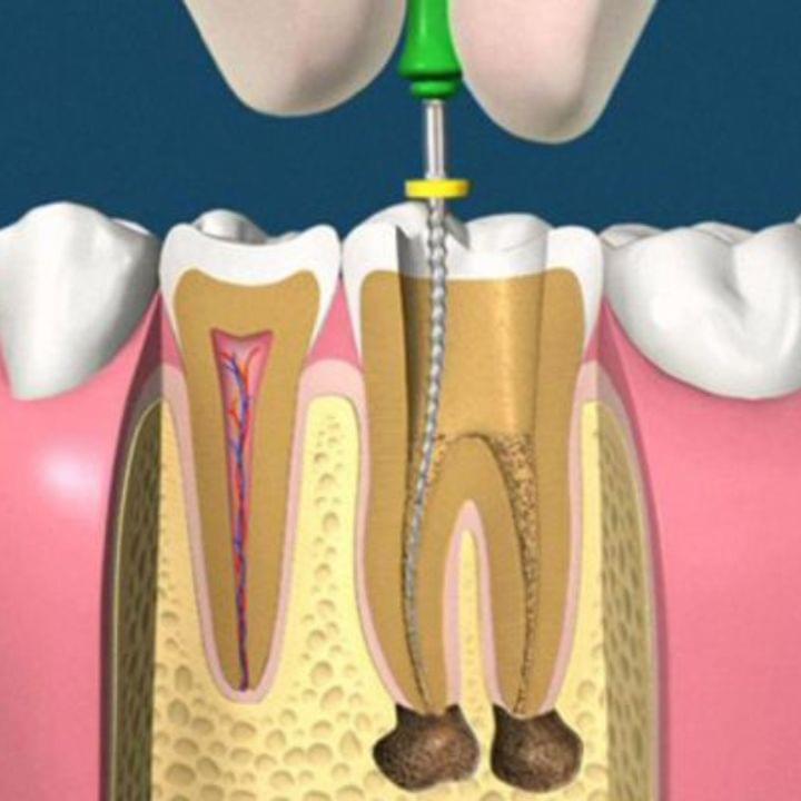 Best Root Canal Treatment in Nizampet