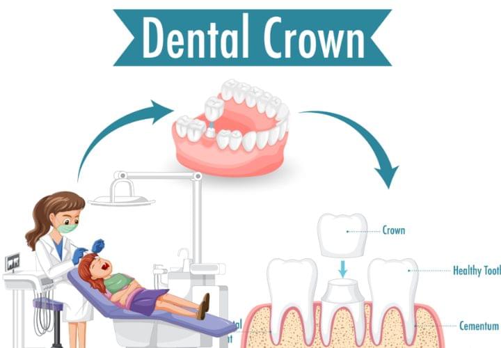 Best Crowns and Bridges Treatment in Nizampet