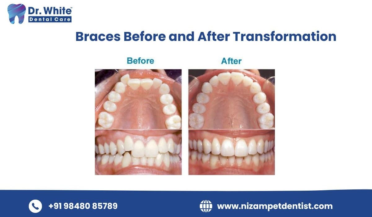 Braces Before and After Transformation