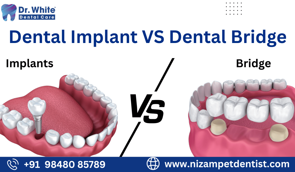 Dental Implant VS Dental Bridge