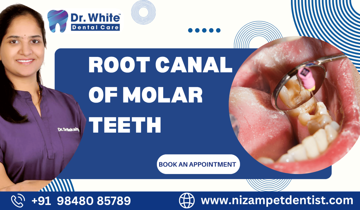 Root Canal of Molar Teeth