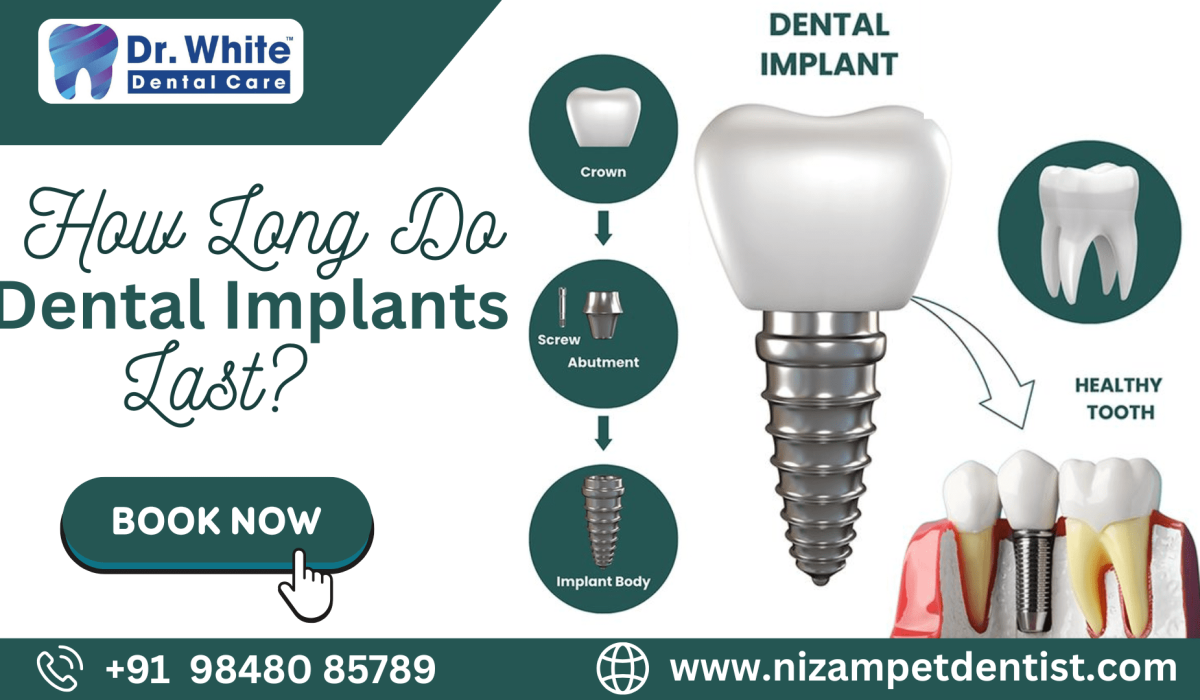 How Long Do Dental Implants Last?