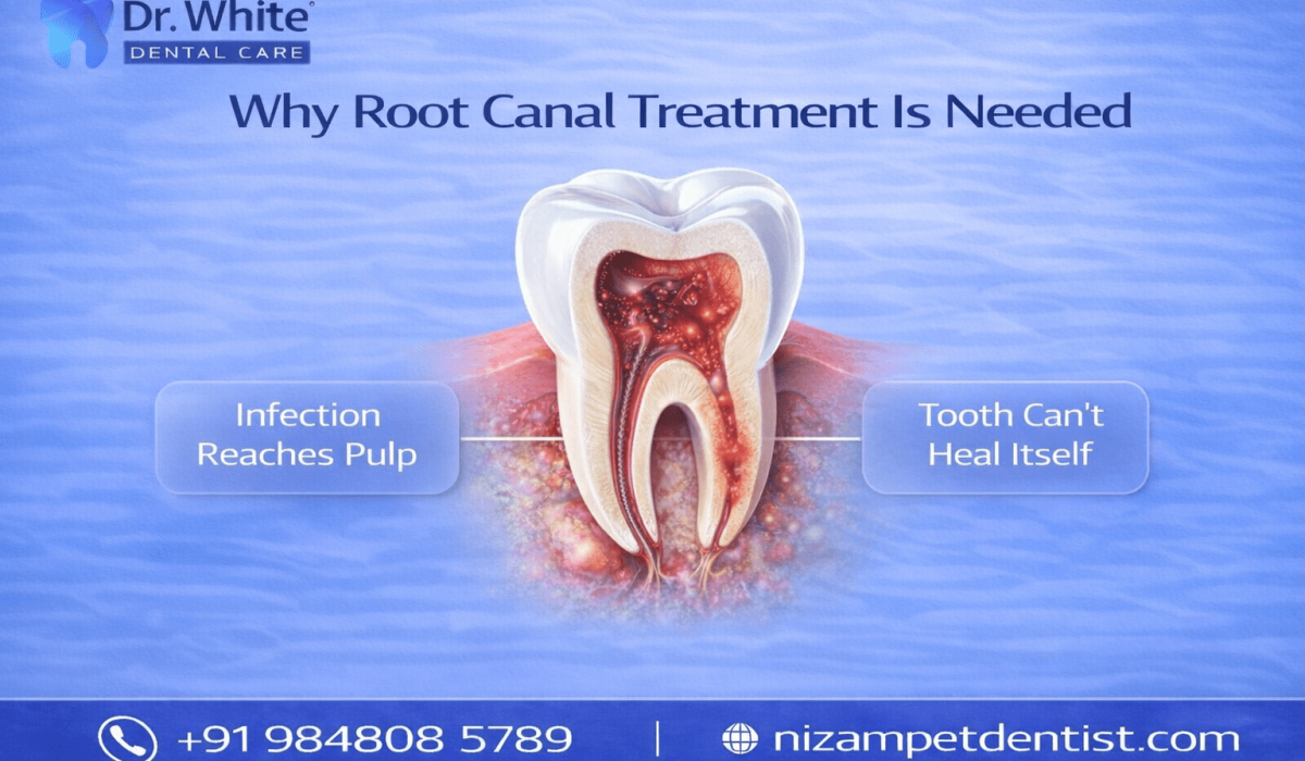 Why root canal treatment is needed