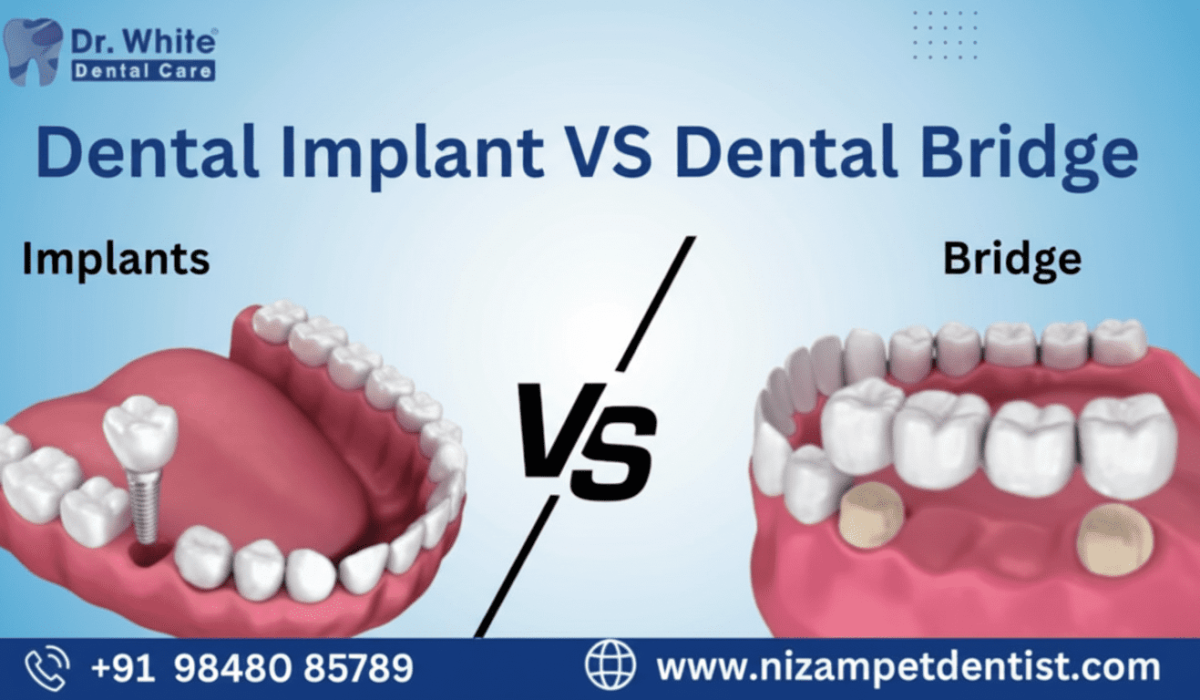 Dental Implant vs Dental bridge
